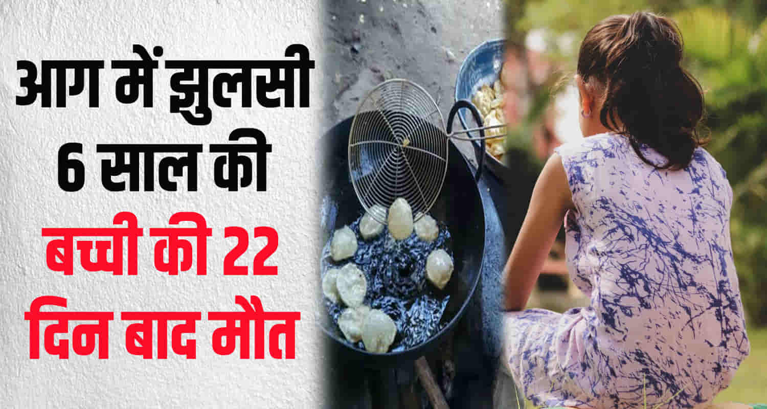 Himachal una 6 year old girl suffers burn injuries treatment pgi 21 days