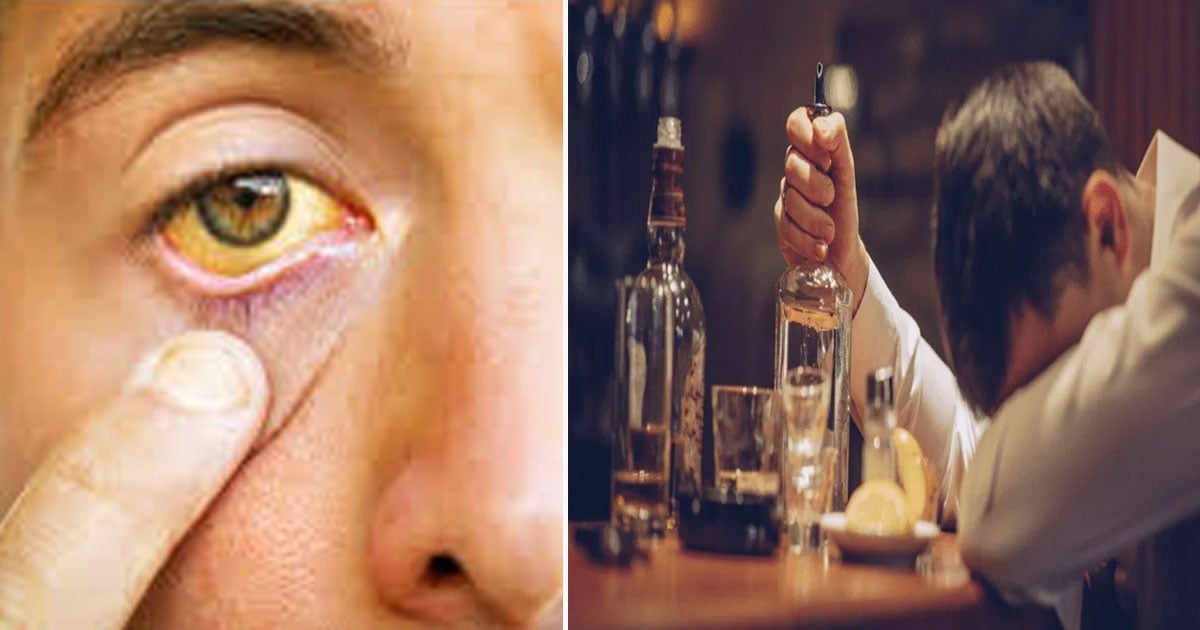 Jaundice alcohol tips cure health care symptoms causes