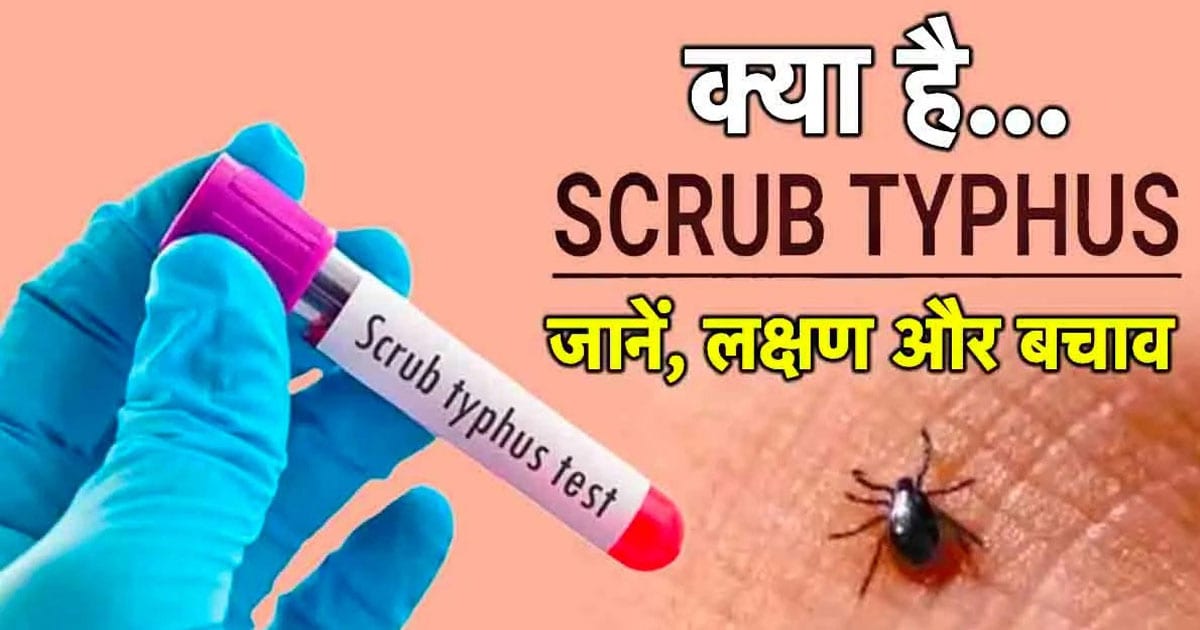 Scrub typhus symptoms cure himachal pradesh monsoon